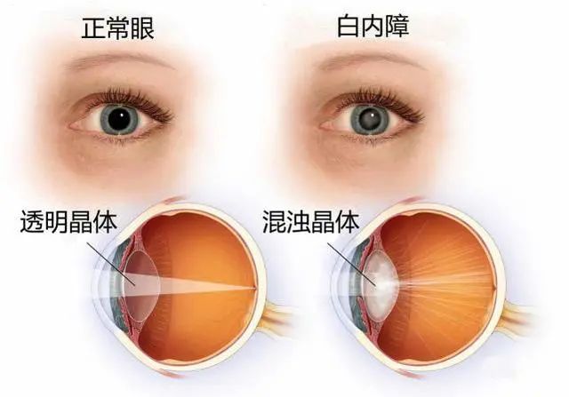 讓視力更清晰舒適的屈光性白內(nèi)障手術(shù)